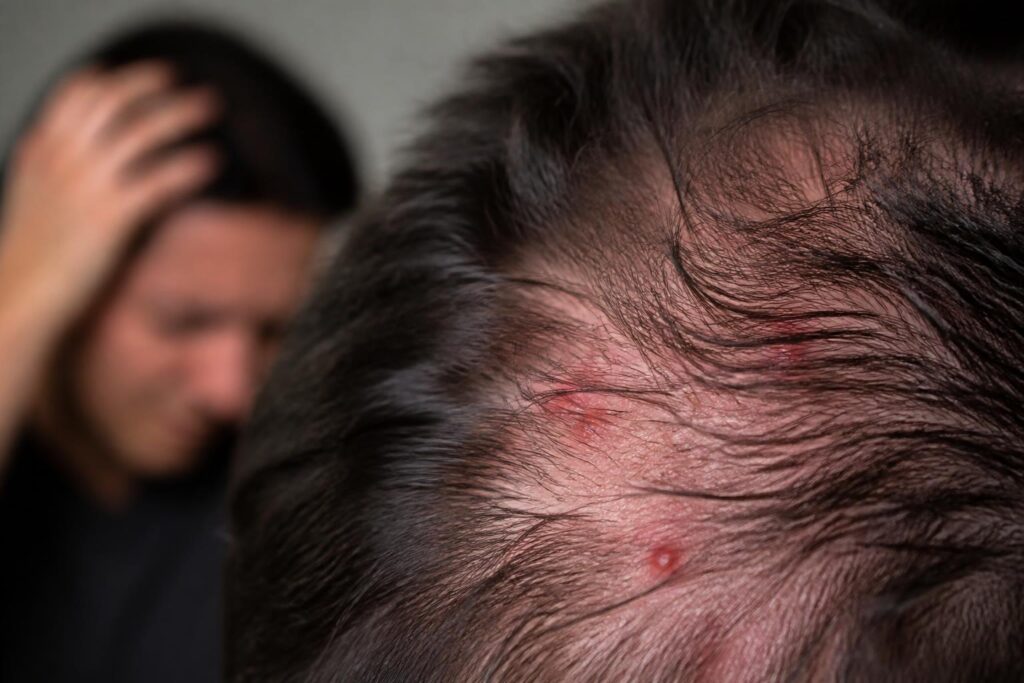découvrez comment le stress peut provoquer des boutons et des démangeaisons sur le cuir chevelu, et apprenez à mieux gérer ces manifestations désagréables pour retrouver confort et sérénité.
